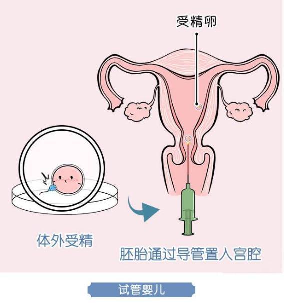 最新人工授精成功率研究，發(fā)展趨勢分析與成功率探討