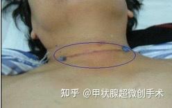 甲亢的最新治療,最新甲亢治療，突破傳統(tǒng)，走向精準(zhǔn)醫(yī)療